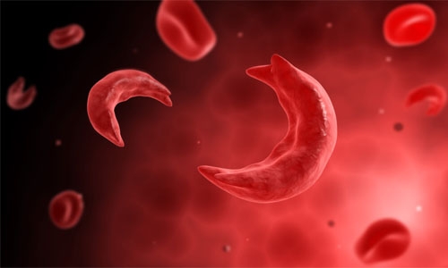 Sickle cell hub in Middle East urged