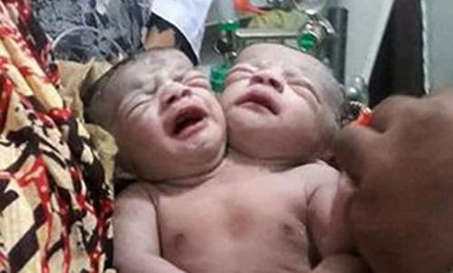 Baby with two heads born in Bangladesh