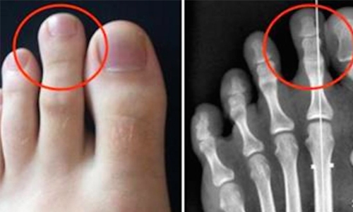 What Does It Mean When Your Second Toe Is Longer Than Your Big Toe