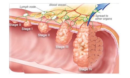 Colorectal cancer on rise in Bahrain; highest in GCC