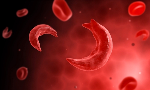 New drug for sickle cell in final stage