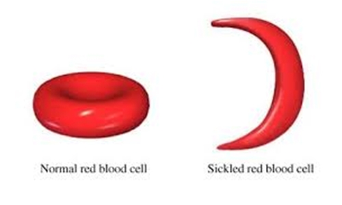 Call for more awareness on sickle-cell disease 
