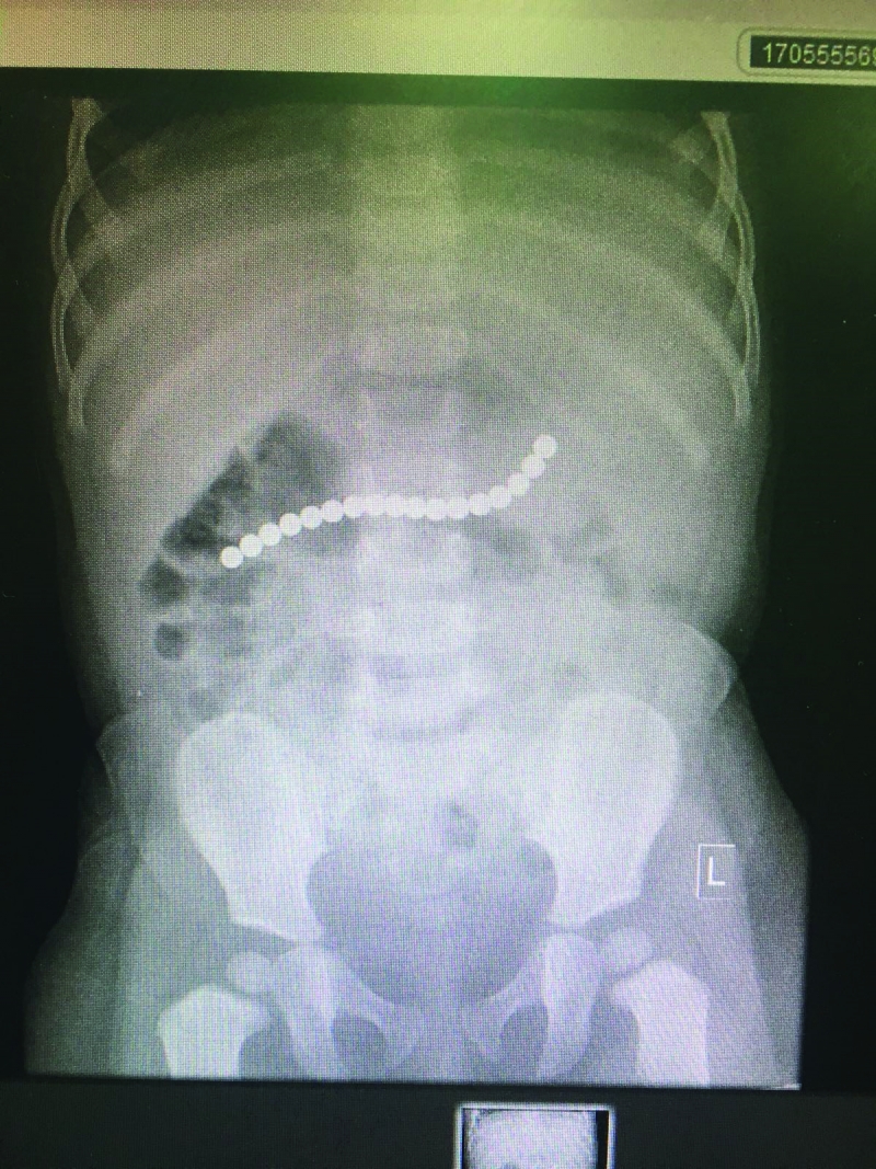 Magnetic beads removed from 14 months old girl’s stomach 