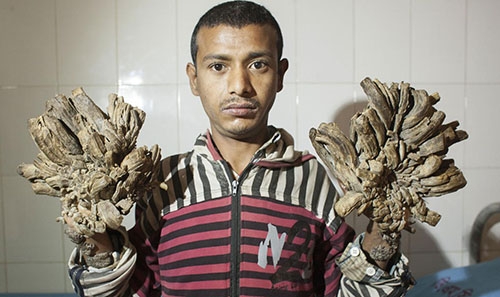 Bangladesh's 'Tree Man' undergoes successful surgery