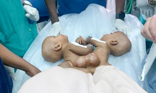 King Hamad University Hospital team succeeds in separating conjoined twins