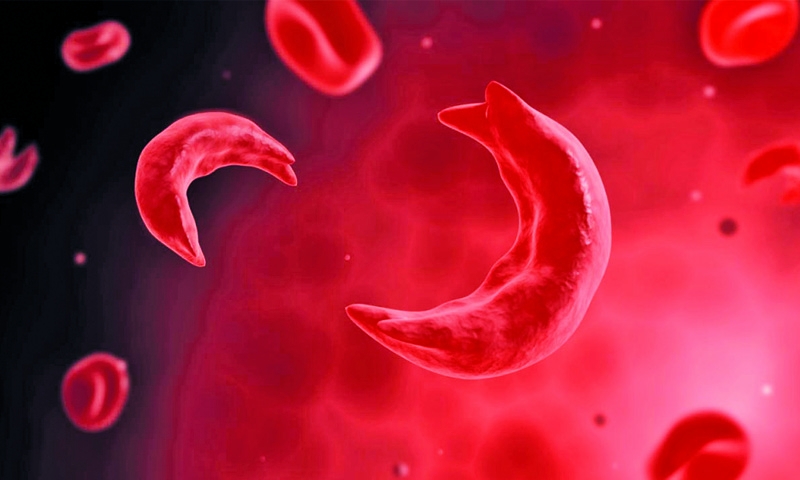 Fighting sickle cell 