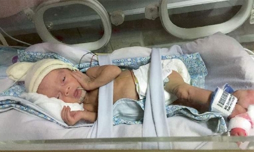 'Tiny' Indian baby in Dubai survives