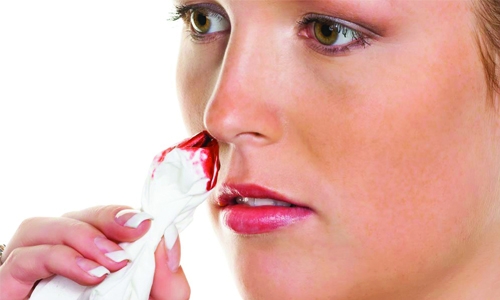 What is nose bleeding?