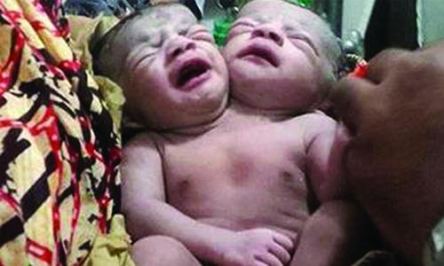 Conjoined Bangladesh newborn twins die