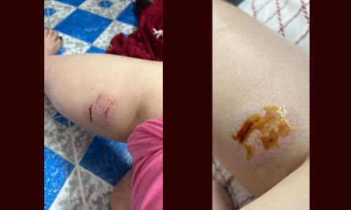 Stray dogs ‘strike’ again, injure woman out for walk in Manama